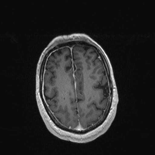 Atypical meningioma (grade II) - en plaque (Radiopaedia 29633-30147 Axial T1 C+ 142).jpg
