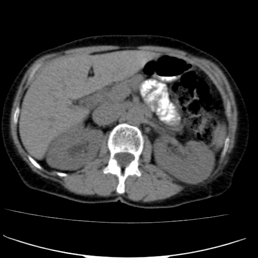 File:Atypical renal cyst (Radiopaedia 17536-17251 non-contrast 11).jpg