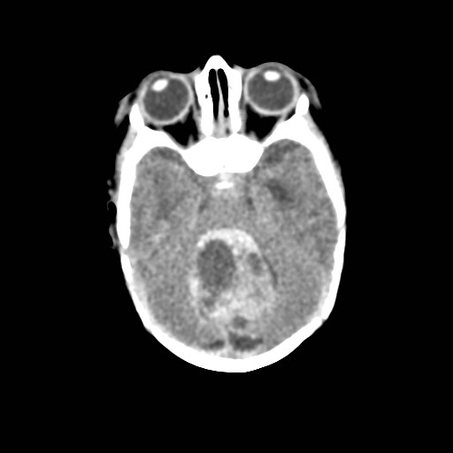 File:Atypical teratoid rhabdoid tumor (prenatal US and neonatal MRI) (Radiopaedia 59091-66387 Axial non-contrast 14).jpg