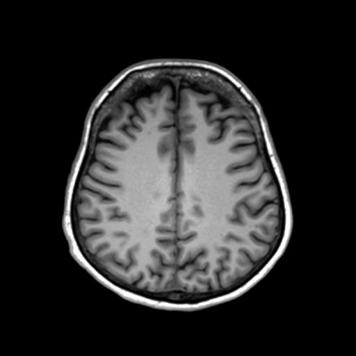 Autoimmune limbic encephalitis (Radiopaedia 30363-31005 T1 Axial 3mm 35).jpg
