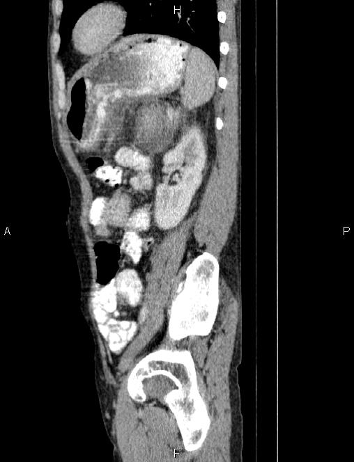 Autoimmune pancreatitis (Radiopaedia 84925-100431 E 69).jpg