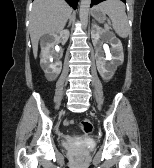 Autosomal dominant polycystic kidney disease (Radiopaedia 38189-40194 Coronal C+ delayed 60).jpg