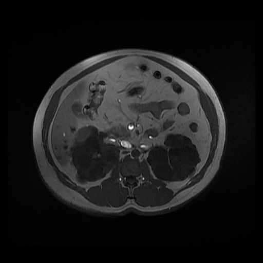 Autosomal dominant polycystic kidney disease (Radiopaedia 50259-55611 Axial 2D Dual Echo 44).jpg