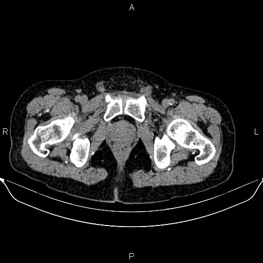 Autosomal dominant polycystic kidney disease (Radiopaedia 87830-104287 Axial non-contrast 56).jpg