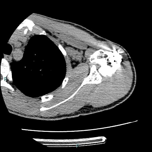 Avascular necrosis after fracture dislocations of the proximal humerus (Radiopaedia 88078-104655 D 55).jpg