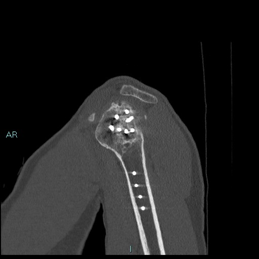 Avascular necrosis after fracture dislocations of the proximal humerus (Radiopaedia 88078-104655 Sagittal bone window 20).jpg