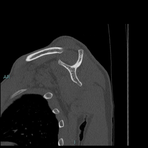 File:Avascular necrosis after fracture dislocations of the proximal humerus (Radiopaedia 88078-104655 Sagittal bone window 40).jpg