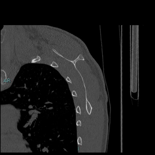 Avascular necrosis after fracture dislocations of the proximal humerus (Radiopaedia 88078-104655 Sagittal bone window 65).jpg