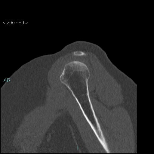 Avascular necrosis of the shoulder - Cruess stage I (Radiopaedia 77674-89887 Sagittal bone window 68).jpg