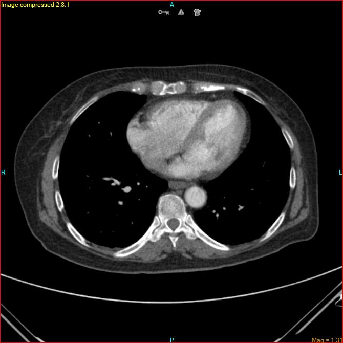 Azygos vein aneurysm (Radiopaedia 77824-90130 B 39).jpg