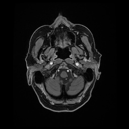 File:Balo concentric sclerosis (Radiopaedia 53875-59982 Axial LAVA C+ 31).jpg