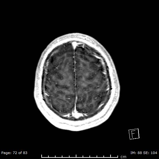 File:Balo concentric sclerosis (Radiopaedia 61637-69636 Axial T1 C+ 72).jpg