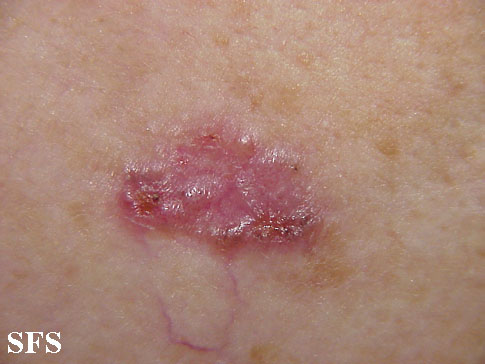 Basal Cell Carcinoma (Dermatology Atlas 44).jpg