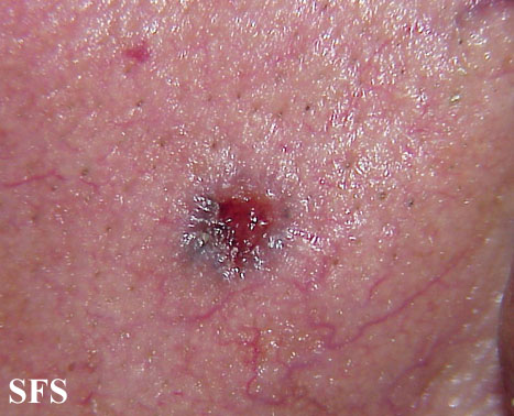 Basal Cell Carcinoma (Dermatology Atlas 62).jpg