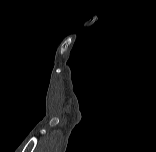 Base of 2nd metacarpal fracture (Radiopaedia 73741-84544 Coronal bone window 16).jpg