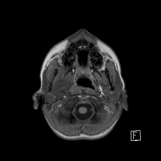 File:Base of skull rhabdomyosarcoma (Radiopaedia 32196-33142 Axial T1 2).jpg