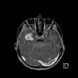 Base of skull rhabdomyosarcoma (Radiopaedia 32196-33142 T1 C+ fat sat 36).jpg