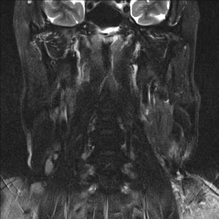 File:Base of tongue squamous cell carcinoma (Radiopaedia 31174-31884 Coronal T2 fat sat 6).jpg