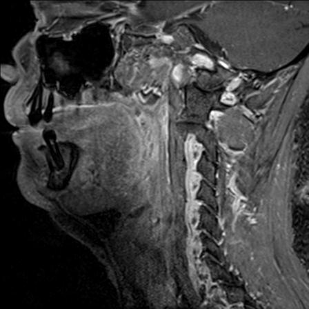 Base of tongue squamous cell carcinoma (Radiopaedia 31174-31884 F 112).jpg