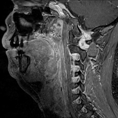 Base of tongue squamous cell carcinoma (Radiopaedia 31174-31884 F 70).jpg