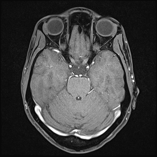 Basilar artery perforator aneurysm (Radiopaedia 82455-97733 Axial T1 fat sat 55).jpg
