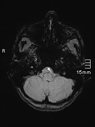 Basilar artery perforator aneurysm (Radiopaedia 82455-99523 Axial SWI 10).jpg