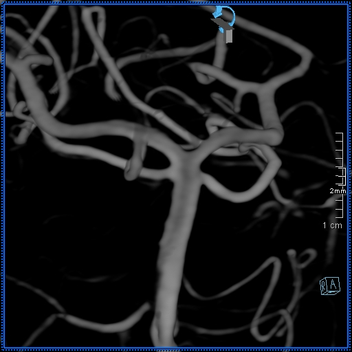 Basilar artery perforator aneurysm (Radiopaedia 82455-99524 3D Left VA 49).jpg