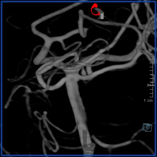 Basilar artery perforator aneurysm (Radiopaedia 82455-99524 3D Left VA 7).jpg