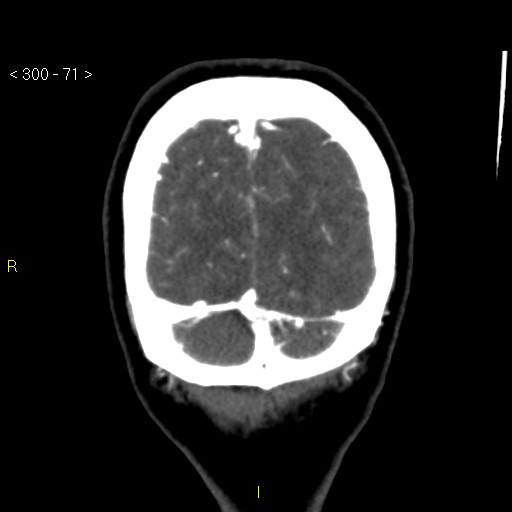 Basilar artery thrombosis (Radiopaedia 16260-15944 B 62).jpg