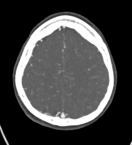 File:Basilar tip aneurysm with coiling (Radiopaedia 53912-60086 A 117).jpg