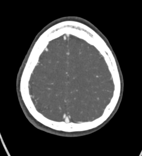 Basilar tip aneurysm with coiling (Radiopaedia 53912-60086 A 123).jpg
