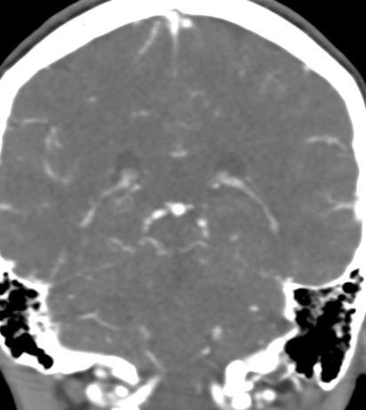 Basilar tip aneurysm with coiling (Radiopaedia 53912-60086 B 102).jpg