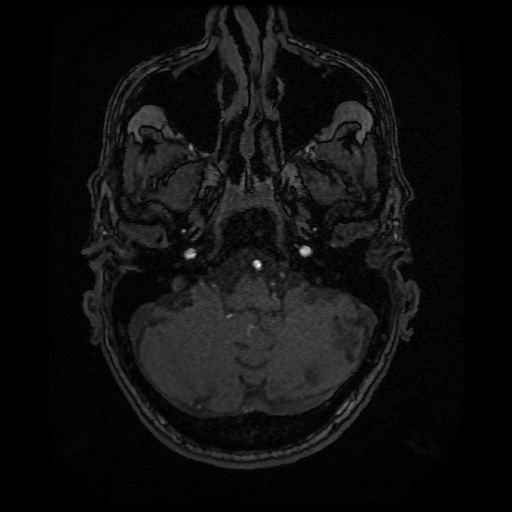 Basilar top and left middle cerebral artery aneurysm (Radiopaedia 61965-70031 Axial MRA 24).jpg
