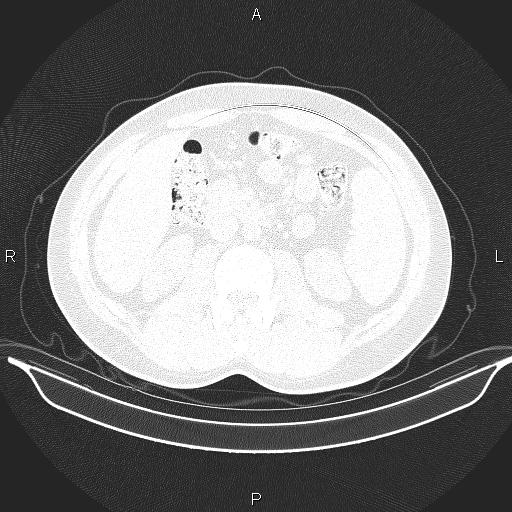 Beam hardening and ring artifacts (Radiopaedia 85323-100915 Axial lung window 88).jpg