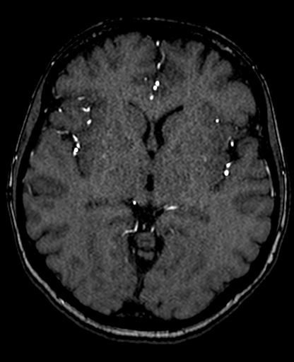 Berry aneurysm of the terminal internal carotid artery (Radiopaedia 88286-104918 Axial TOF 123).jpg