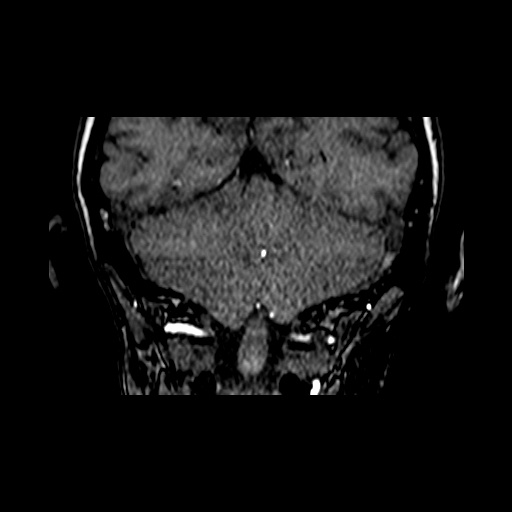 File:Berry aneurysm of the terminal internal carotid artery (Radiopaedia 88286-104918 Coronal TOF 89).jpg