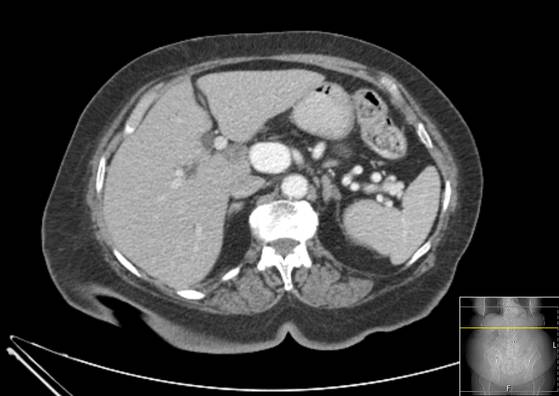 Bicameral celiacomesenteric aneurysm (Radiopaedia 55766-62327 A 16).jpg