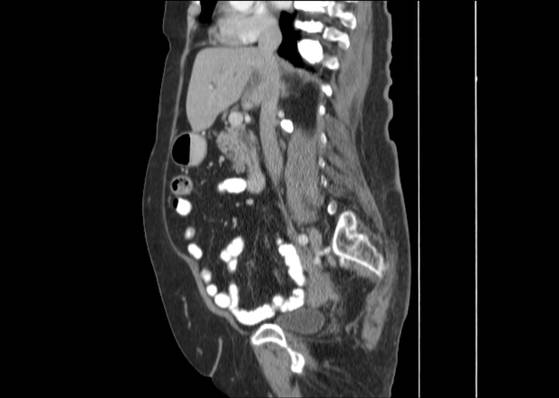 Bicameral celiacomesenteric aneurysm (Radiopaedia 55766-62327 B 25).jpg