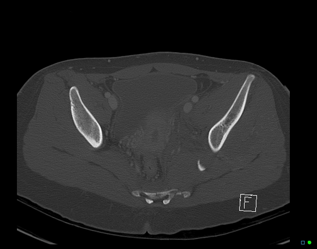 Bilateral acetabular fractures (Radiopaedia 79272-92308 Axial bone window 34).jpg