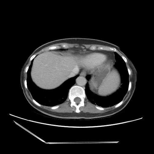 File:Bilateral adrenal granulocytic sarcomas (chloromas) (Radiopaedia 78375-91007 A 18).jpg