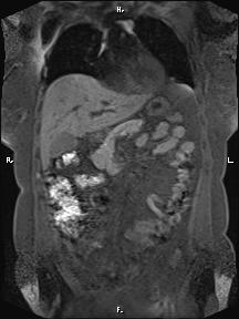 File:Bilateral adrenal myelolipoma (Radiopaedia 63058-71537 Coronal T1 fat sat 71).jpg