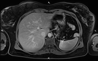 File:Bilateral adrenal myelolipoma (Radiopaedia 63058-71537 H 25).jpg