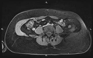 File:Bilateral adrenal myelolipoma (Radiopaedia 63058-71537 H 76).jpg