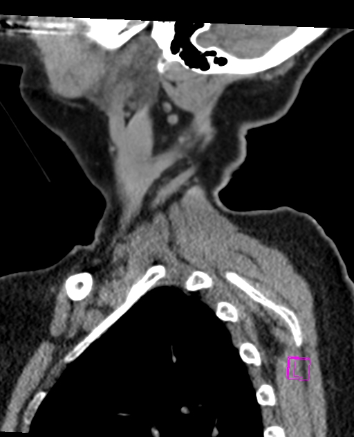 Bilateral atlanto-occipital assimilation (Radiopaedia 28350-28603 D 7).jpg