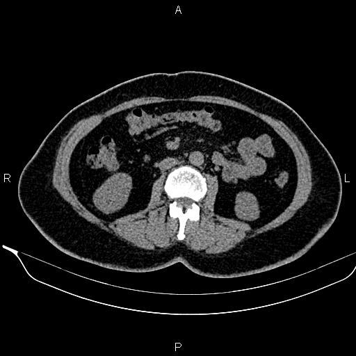 Bilateral benign adrenal adenomas (Radiopaedia 86912-103124 Axial non-contrast 57).jpg