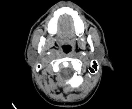 Bilateral carotid body tumors (Radiopaedia 61841-69870 Axial non-contrast 19).jpg