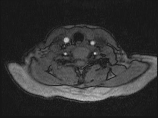 Bilateral carotid body tumors and right glomus jugulare tumor (Radiopaedia 20024-20060 Axial MRA 207).jpg
