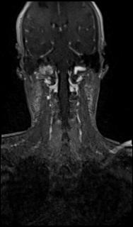 File:Bilateral carotid body tumors and right glomus jugulare tumor (Radiopaedia 20024-20060 MRA 50).jpg
