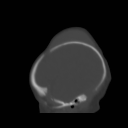 File:Bilateral cephalohematomas and subdural hematomas (Radiopaedia 26778-26929 Sagittal bone window 35).jpg