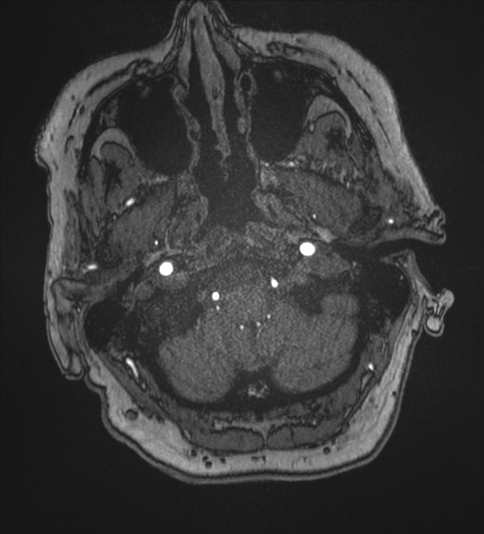 Bilateral fetal posterior communicating arteries (Radiopaedia 41286-44102 Axial MRA 6).png